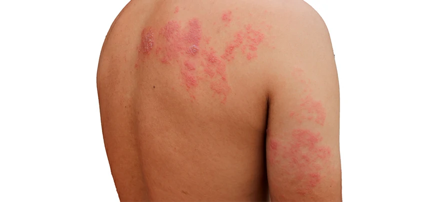 Herpes Zoster Y Neuralgia Postherpetica